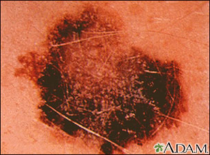 Skin cancer, melanoma - flat, brown lesion