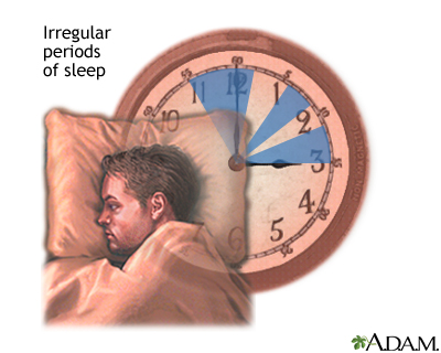 Irregular sleep