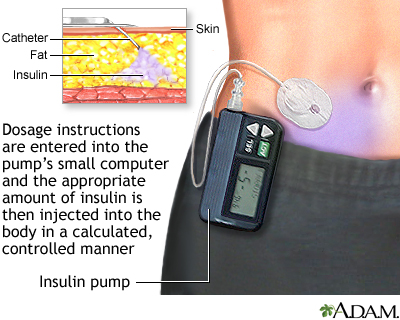 Insulin pump