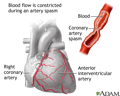 Coronary artery spasm