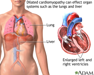 Dilated cardiomyopathy