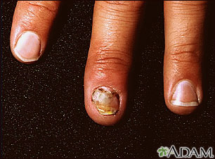 Fungal nail infection | UF Health, University of Florida Health