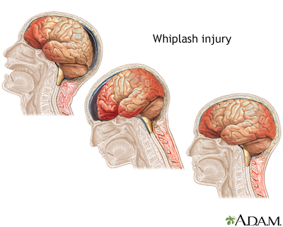 Whiplash | UF Health, University of Florida Health tbi head diagram 