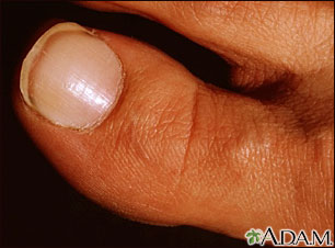 White nail syndrome