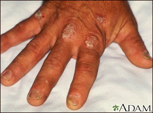 Psoriasis on the knuckles