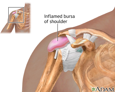 Bursitis of the shoulder