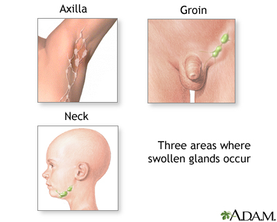 Swollen groin remedies for in lymph natural nodes 14 Immediate