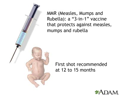 Meaning mmr vaccine Ask the