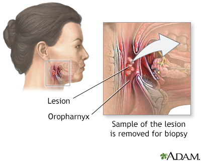 Oropharyngeal biopsy