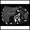 Adrenal metastases - CT scan