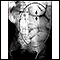 Ileus - X-ray of bowel distension