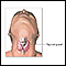 Thyroidectomy - Series