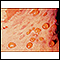 Bullous pemphigoid - close-up of tense blisters