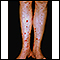 Henoch-Schonlein purpura on the lower legs