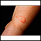 Ringworm - tinea corporis on an infant's leg