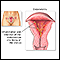 Endometritis