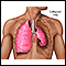 Collapsed lung, pneumothorax