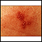 Herpes simplex - close-up