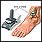 Ankle replacement