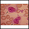 Mononucleosis - photomicrograph of cell