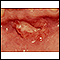 Canker sore (aphthous ulcer)