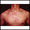Acne - cystic on the chest