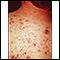 Acne - vulgaris on the back