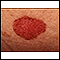 Skin cancer, basal cell carcinoma - spreading