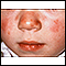 Lupus - discoid on a child's face