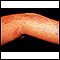 Herpes zoster (shingles) on the arm