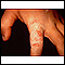 Ringworm - tinea manuum on the finger