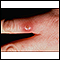 Leishmaniasis on the finger