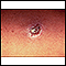 Leishmania panamensis - close-up