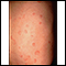 Hives (urticaria) on the back