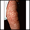 Cutis marmorata on the leg