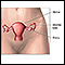 Hysterectomy - Series