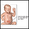 Infant abdominal hernia (gastroschisis)