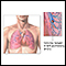 Pulmonary embolus