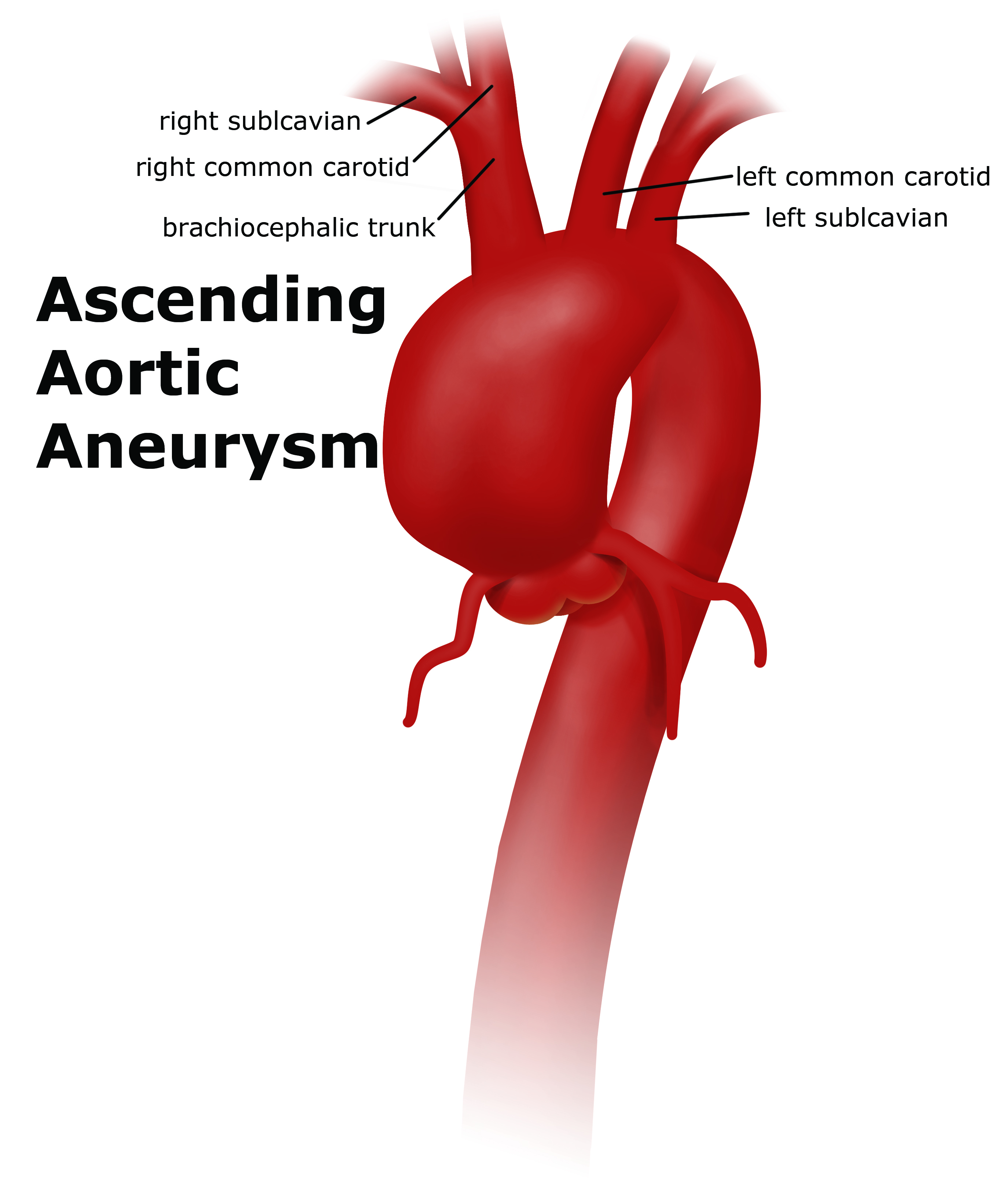 Thoracic Aortic Aneurysm Uf Health Aortic Disease Center