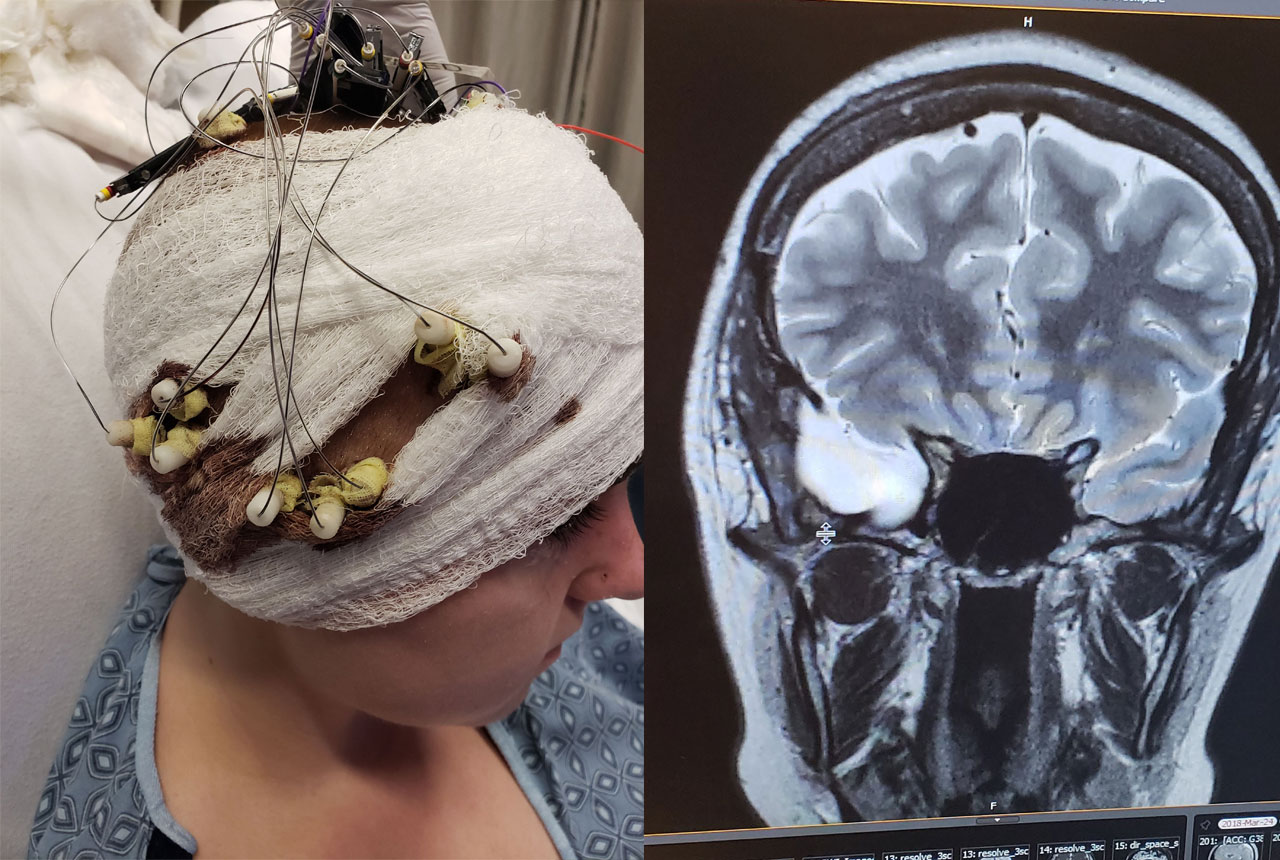 Left: As part of her evaluation, depth electrodes were placed in various parts of Brooklynn’s brain. Right: The SEEG pinpointed the seizure focus that led to the temporal lobe being removed to cure her epilepsy.