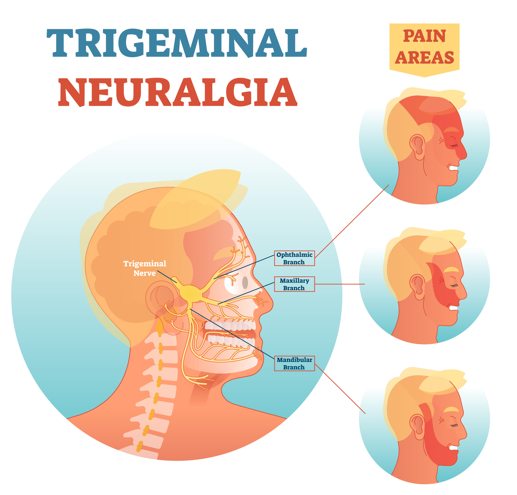 trigeminal neuralgia graphic
