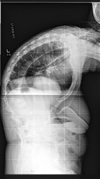 Ankylosing Spondylitis pre-operative x-ray