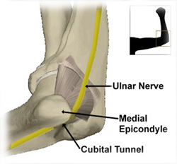 cubital tunnel syndrome