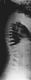 Post-Operative X-Ray of flat back syndrome