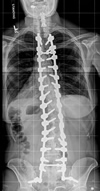 post-operative x-ray of scoliosis patient 