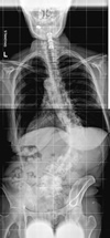 pre-operative x-ray of an elderly patient with scoliosis