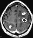 MRI of a brain abcess