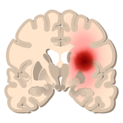 brain tumor image