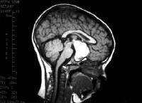 Craniopharyngioma scan