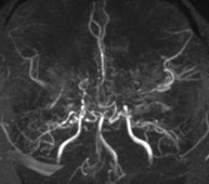 CT-angiogram and MR-angiogram of moyamoya disease